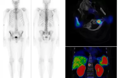 Bone Scan in Gurgaon, Bone Scan Test for Bone Cancer, Best Centre for Bone Scan