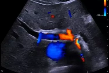 carotid arteries colour doppler, colour doppler for brain blood vessels, best radiologist for carotid artery colour doppler, cost of carotid colour doppler, best diagnostic centre in gurgaon